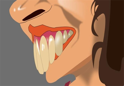 王凯潆医生讲解龅牙是怎么形成的