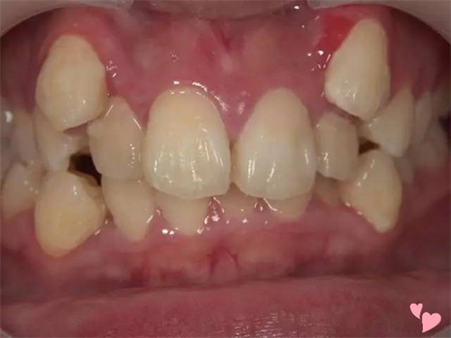 八重齿是什么牙齿图片