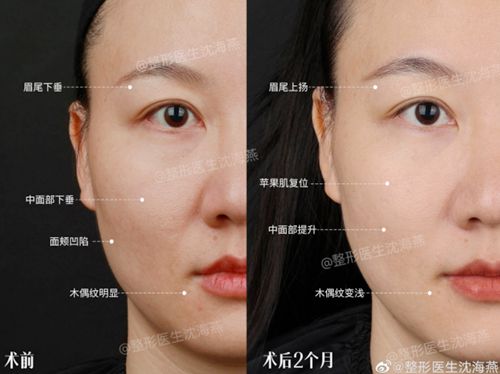 杭州市第 一人民医院医疗美容科沈海燕医生双眼皮手术怎么样？