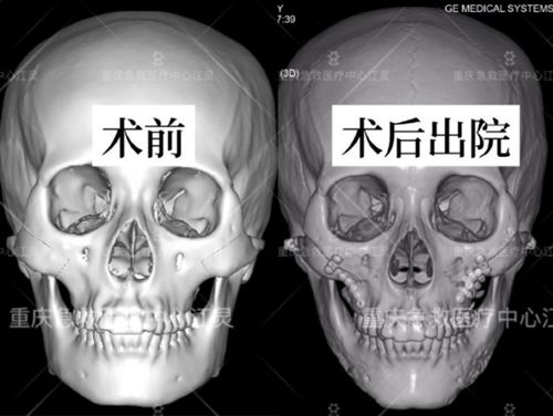 重庆市急救医疗中心整形外科面部轮廓整形医生江灵下颌角磨骨图片