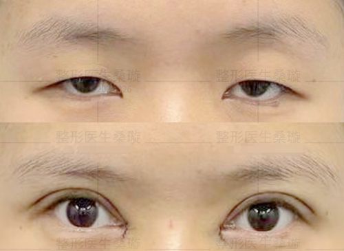 西安目秀医疗美容桑璇医生双眼皮手术图片