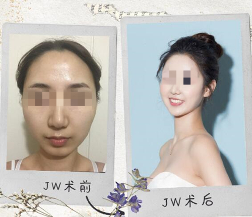 韩国JW整形外科面部轮廓真人实例